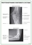 Рентгенография локтевого сустава