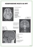 Изображение мозга на МРТ